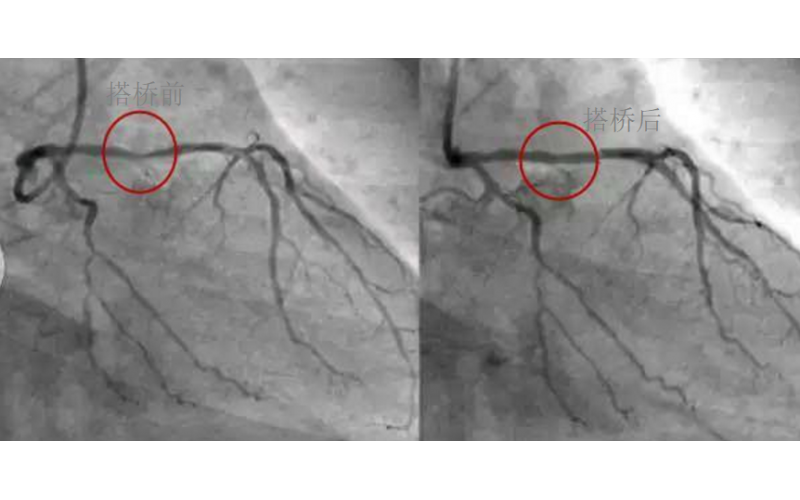 深圳市模具廠對(duì)心臟支架的關(guān)注，國(guó)產(chǎn)化的道路有多長(zhǎng)？